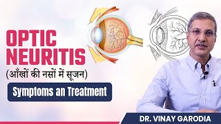 What is Optic Neuritis  Symptoms and Treatment  Synergy Eye Care [upl. by Natsyrk700]