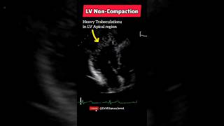 Heavy Trabeculations in Left Ventricular Apical Region  Echocardiography Made Easy [upl. by Ahsei]