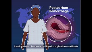 Early Detection and Treatment of Postpartum Hemorrhage  NEJM [upl. by Dnomrej]