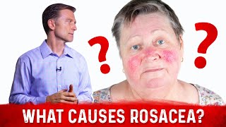 Dr Berg’s Opinion on Causes of Rosacea and Its Treatment [upl. by Haywood]