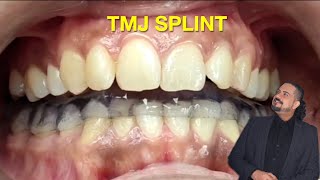 Michigan TMJ Splint tmd tmjpain tmjdisorder tmjtreatment [upl. by Montague]