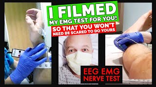 Preparing for EEG test Electromyography EMG Neurology Muscles and nerve tests UNC Hospital VLog [upl. by Redle973]