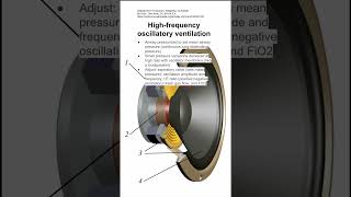 Highfrequency oscillatory ventilation [upl. by Rollie]