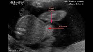 Omphalocèle à 23 SA sans anomalie de caryotype  Description [upl. by Theresa]