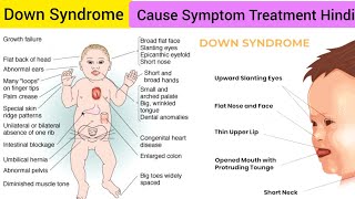 Down Syndrome Cause Symptoms Diagnosis Treatment in Hindi  Trisomy 21 Cause Symptom Treatment Hindi [upl. by Enneiviv]