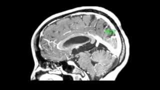 Endoscopic treatment of a third ventricle choroid plexus cyst [upl. by Cromwell]