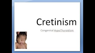 Pediatrics 135 Cretinism Congenital HypoThyroidism Child Umbilical Hernia Tongue Jaundice LOW ALP [upl. by Barbette795]