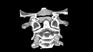 Cervical spine CT scan Atlantoaxial subluxation [upl. by Ellekram369]