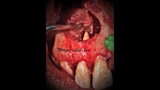 enucleation of maxillary radicular cyst with PRF placement [upl. by Nolyd]