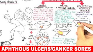 Aphthous Ulcers  Canker Sores  Pathophysiology Triggers Types amp Treatment [upl. by Necyrb]