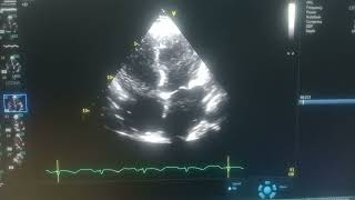 ALL FOUR CHAMBERS DILATED GLOBAL HYPOKINESIA OF LV MILD MR SEVERE LV MODERATE TR [upl. by Mccready]