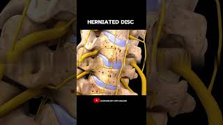 Spine model  Herniated disc  Anatomy [upl. by Delores]