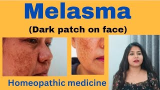 Melasma  Dark patch on face  treatment  Melasma symptomscauses amp homeopathic medicine in hindi [upl. by O'Donoghue]