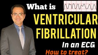 Ventricular Fibrillation V Fib ECG Interpretation Explained Treatment Management USMLE NCLEX [upl. by Eulau]