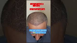 Hair Transplant After 10 days cracks problem calmdown amor love [upl. by Eirellam360]