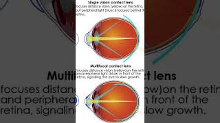 treatments myopia [upl. by Neilson]