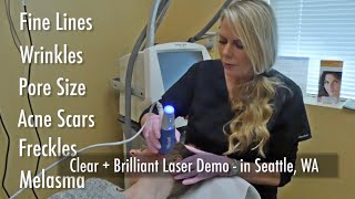 ClearBrilliant Laser Demo Video by Seattle Pacific Dermatology amp Cosmetic Center [upl. by Hebrew]