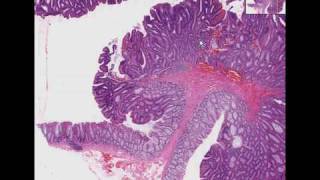 Histopathology Colon Tubular adenoma adenomatous polyp [upl. by Odraleba]