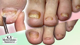 CUTICLE Cleaning on FUNGAL TOENAILS Transformation [upl. by Neetsyrk]