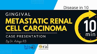 Metastatic Renal cell carcinomaOralpathology360 [upl. by Ahsatel676]