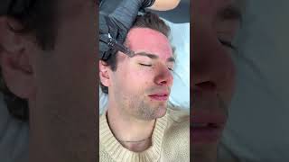 Microneedling facial at Dr Medispa [upl. by Ricard]