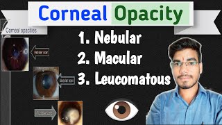 Corneal Opacity  The Cornea  MKSharma Ophthalmic Education Ophthalmology [upl. by Onaicilef488]