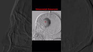 Intracranial Aneurysm radiology brain neurology [upl. by Karlie]