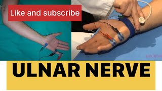 NCS of Ulnar nerve  nerve conduction study of ULNAR nerve neurotech ncs neurology [upl. by Jahdol967]