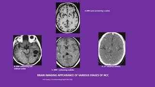 Neurology Quiz 20 Topics Neurocysticercosis NCC and drug induced myopathies [upl. by Harbour827]