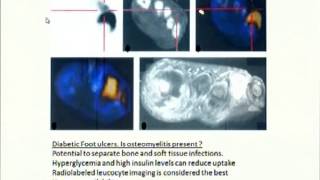 PET Scan in Orthopaedics [upl. by Novert254]