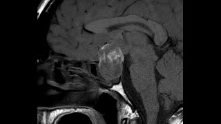 Pituitary apoplexy associated with macroadenoma  CT MRI and CT angiogram findings [upl. by Havstad]