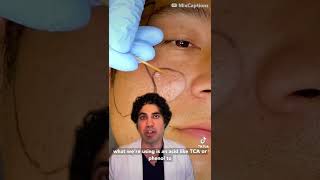 Ice Pick Scar Treatment by Dr Nadir Qazi [upl. by Ennaitsirhc756]