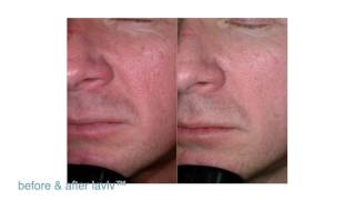 FDAApproved LaViv Fibroblast Treatment  Maryland Laser Skin amp Vein [upl. by Brien732]