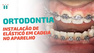 Dica de Ortodontia Como instalar o Elástico em Cadeia no Aparelho de 1o molar a 1 molar inferior [upl. by Esej483]