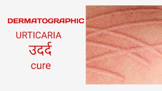 Dermatographic urticaria treatment urticaria ayurveda [upl. by Joo]