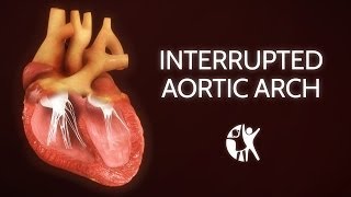 Interrupted Aortic Arch − Ventricular Septic Defect [upl. by Htial]