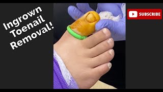 Ingrown toenail removal [upl. by Hairaza]