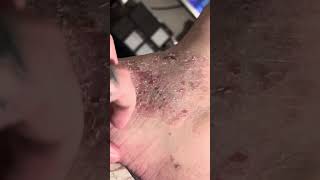 Eczema psoriasis asmr scratching 2 [upl. by Oner576]