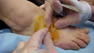 Video  failed ganglion aspiration 02 massive drainage with a scalpel [upl. by Lachance]