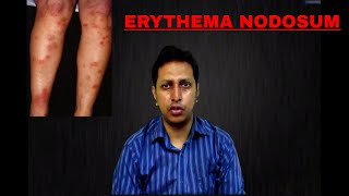 Erythema Nodosum Important Points causes  symptoms  investigations  treatment [upl. by Atileda]