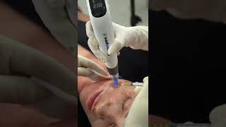 PRP  Microneedling with Dermapen [upl. by Adnalor]