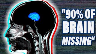 The Most Bizarre Medical Case in Neuroscience [upl. by Forlini415]