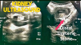 How to Renal Ultrasound  Hydronephrosis Hydroureter Distal Ureteral Stone [upl. by Gena969]