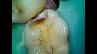 55 Interproximal Decay Restoration [upl. by Cottrell]