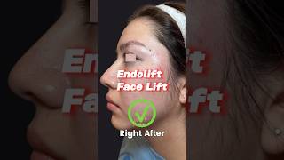 The 3000 Endolift Laser Skin Tightening RESULTS [upl. by Annemarie]