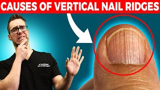 🖐Do you have Vertical Nail Ridges Causes amp Treatment🖐 [upl. by Sowell780]