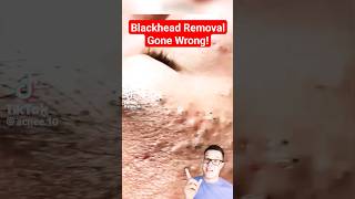 TERRIBLE BLACKHEAD REMOVAL  Shocked At This One shorts [upl. by Larianna]