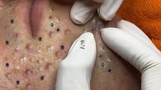 Treatment Of Blackheads And Hidden Acne 067 [upl. by Ellenaej]