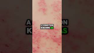 How to Cure Shingles Fast [upl. by Audres]