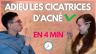 En finir avec les cicatrices d’acné en 4 minutes [upl. by Okomot202]